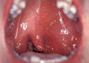 Абсцесс горла: симптомы, причины и лечение медикаментами и оперативными методами