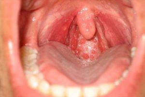Причины и лечение стрептококковой инфекции в горле
