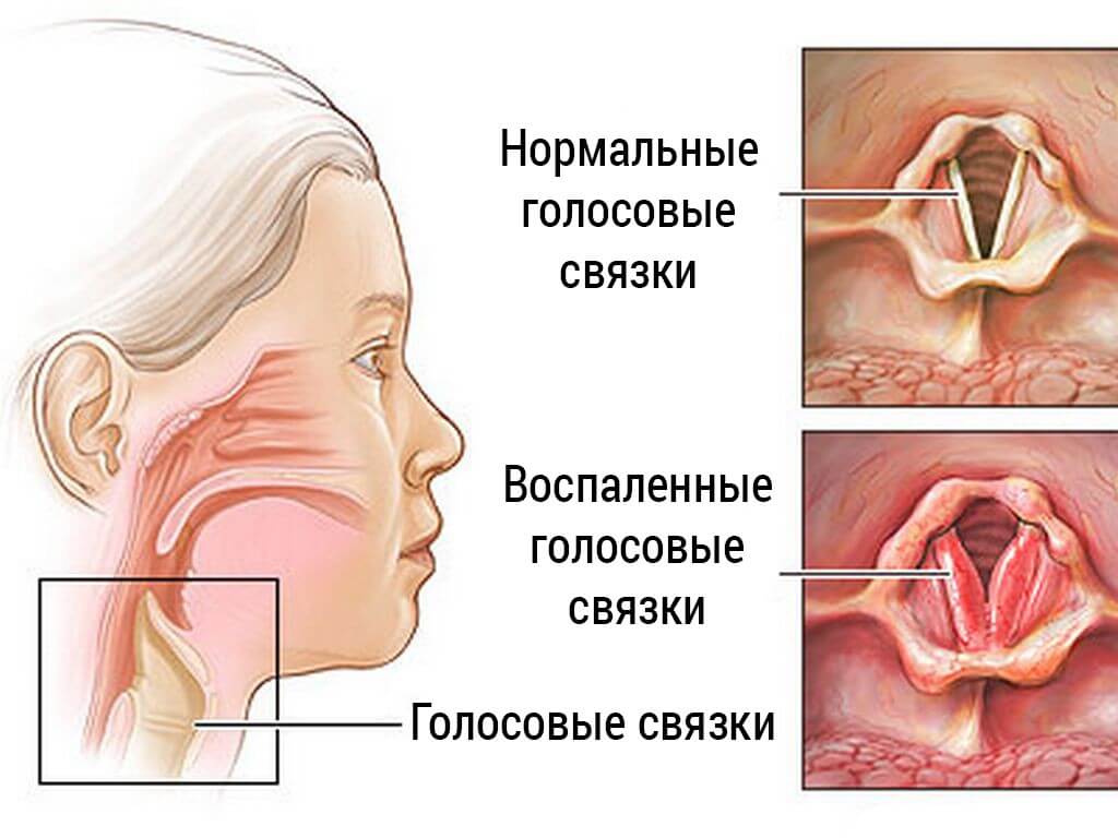 как восстановить голосовые связки в домашних условиях