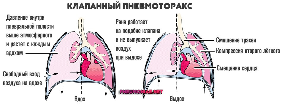 клапанный пневмоторакс