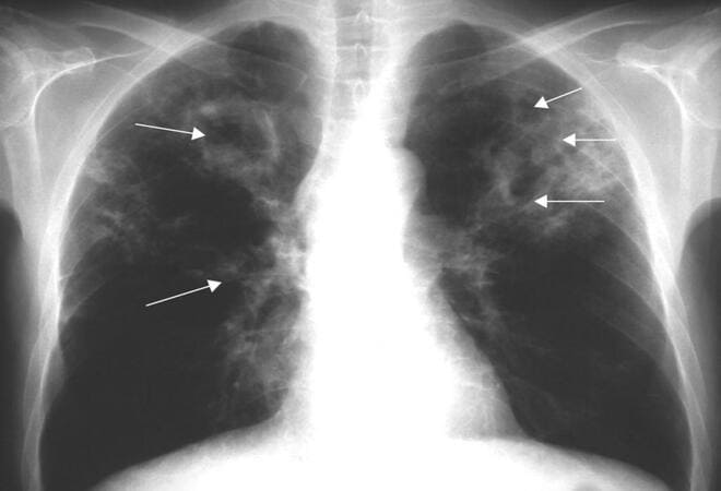туберкулез на рентгене