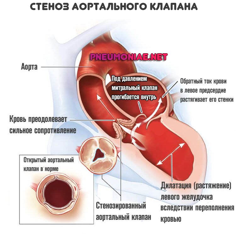 стеноз-аортального-клапана