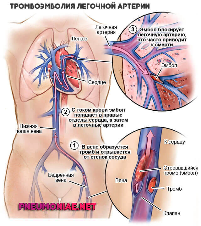 tromboemboliya-legochnoj-arterii
