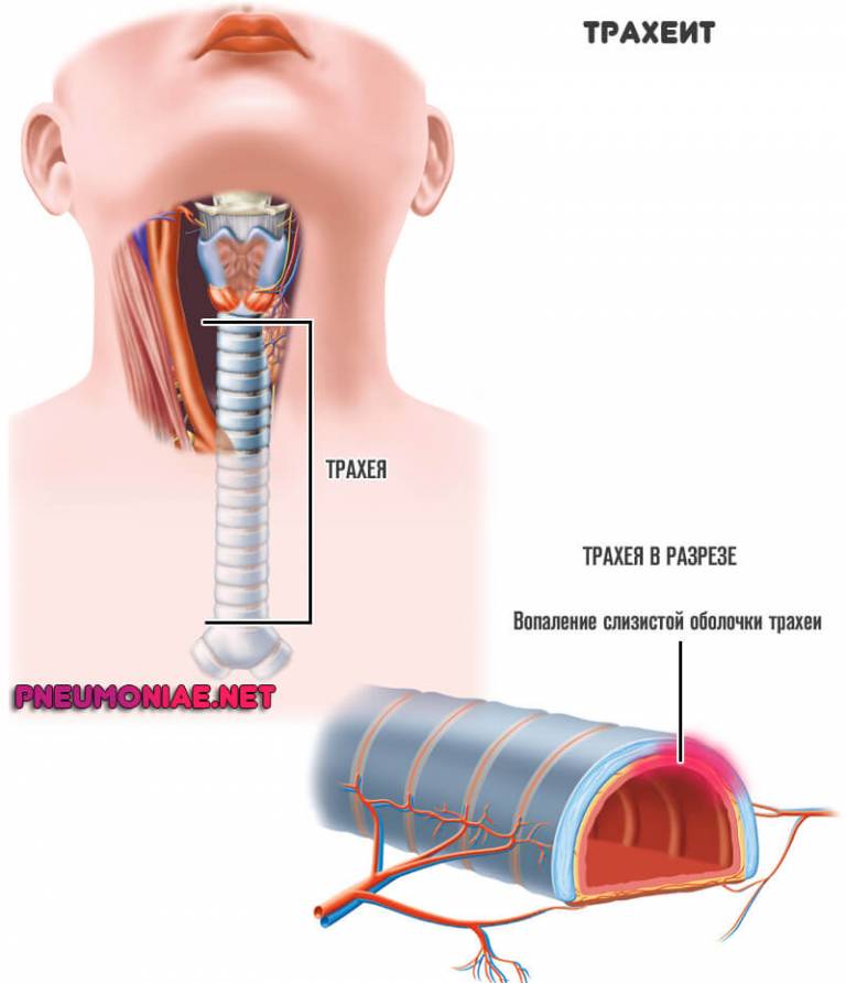 Трахеит фото как выглядит