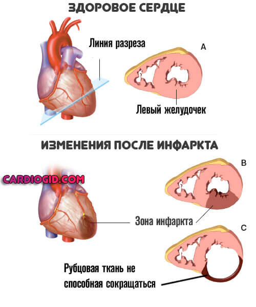кардиосклероз-после-инфаркта