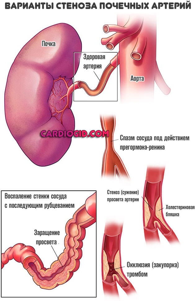 стеноз-почечных-артерий
