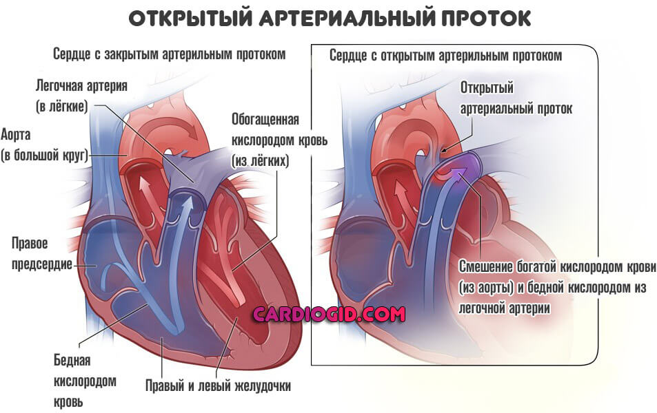открытый-артериальный-проток
