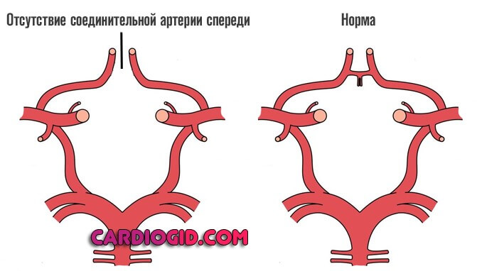 Отсутствие соединительной артерии спереди