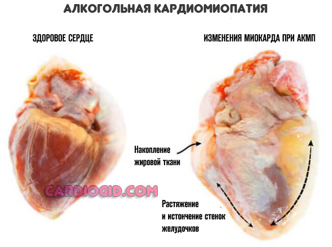 alkogolnaya-kardiomiopatiya