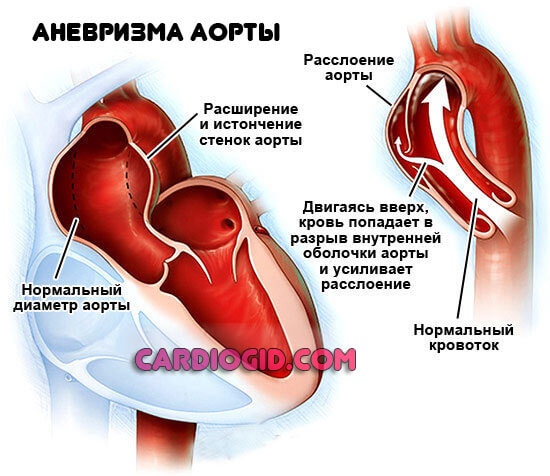 аневризма-аорты-сердца