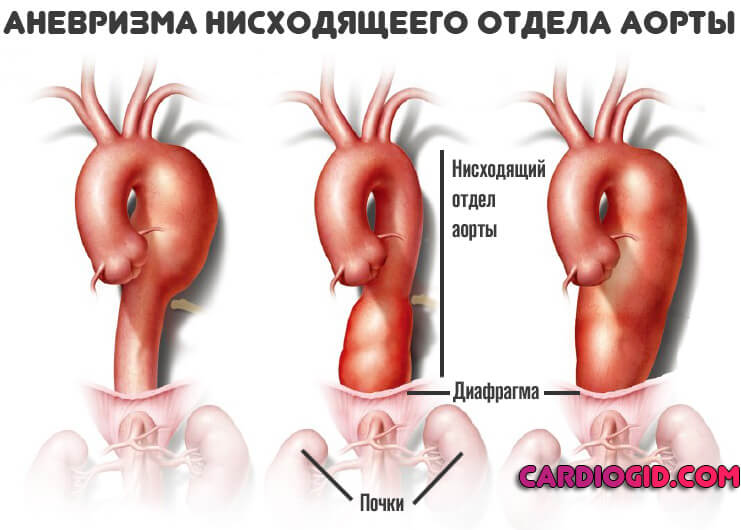 аневризма-нисходящего-отдела-аорты