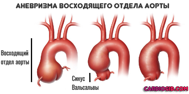 аневризма-восходящего-отдела-аорты