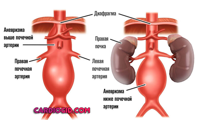 аневризма-выше-и-ниже-почечной-артерии