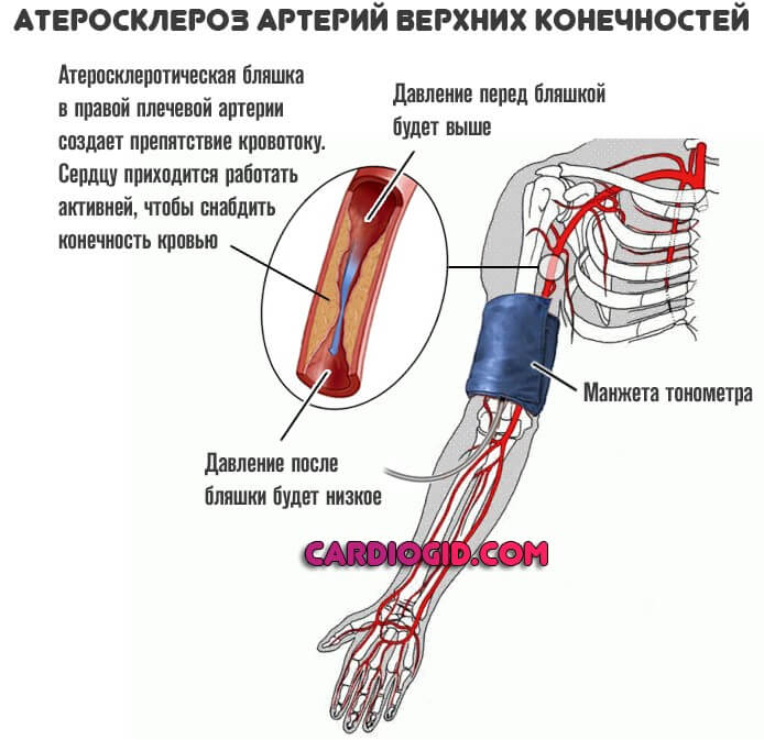 атеросклероз артерий верзних конечностей
