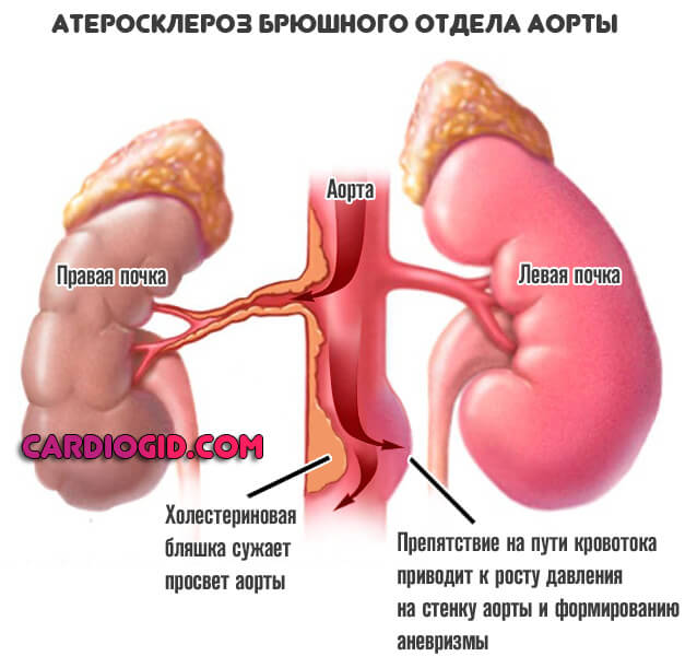 атеросклероз-брюшного-отдела-аорты