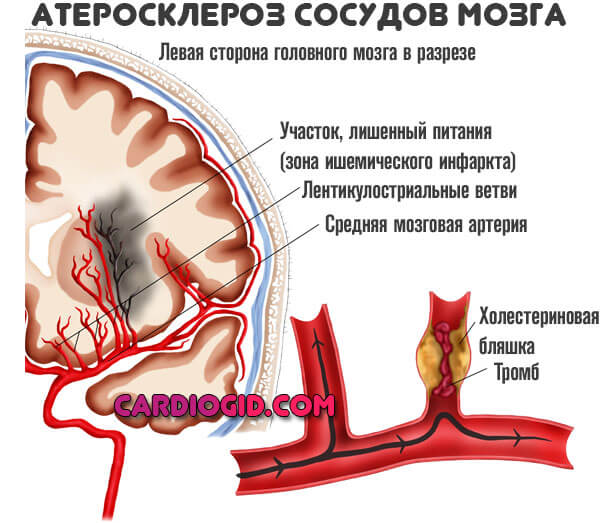 атеросклероз-сосудов-мозга