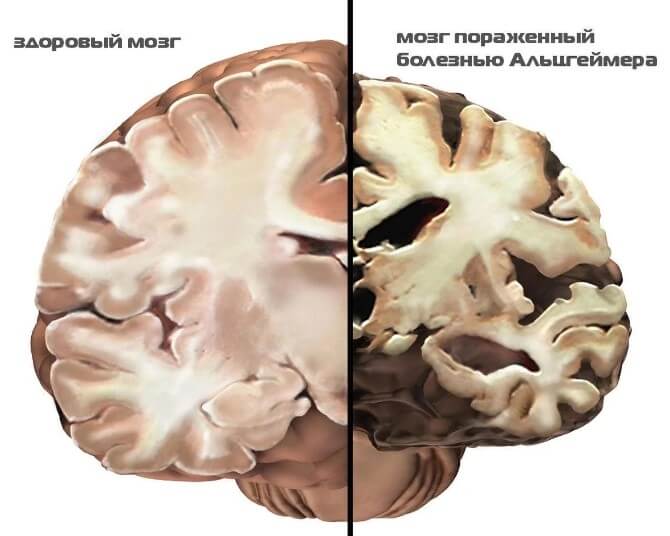 болезнь альцгеймера