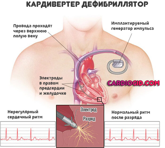 дефибрилятор-кардиовертер