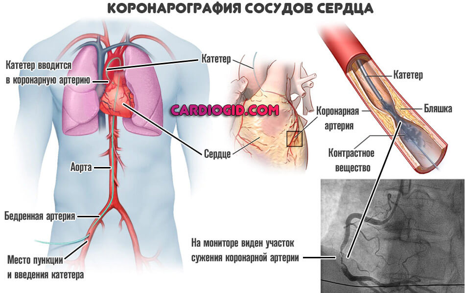 коронарография-сосудов-сердца