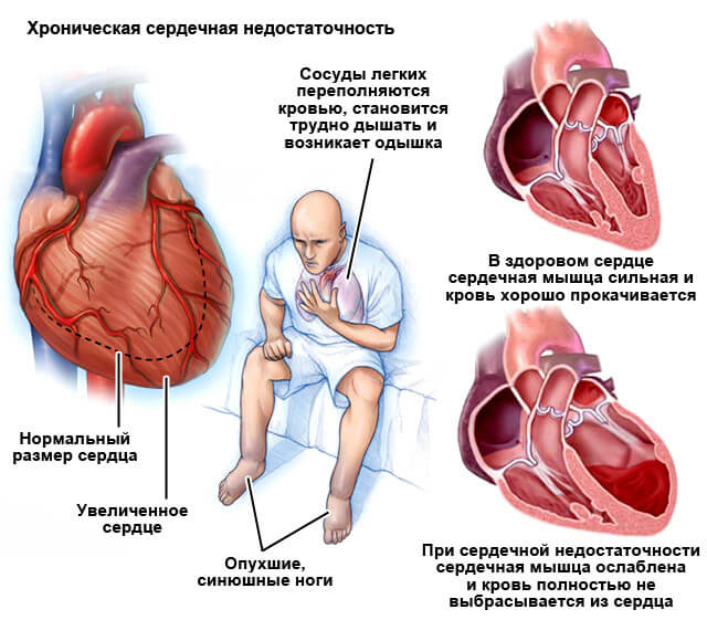 Первые признаки сердечной недостаточности у мужчин, симптомы острой и хронической формы