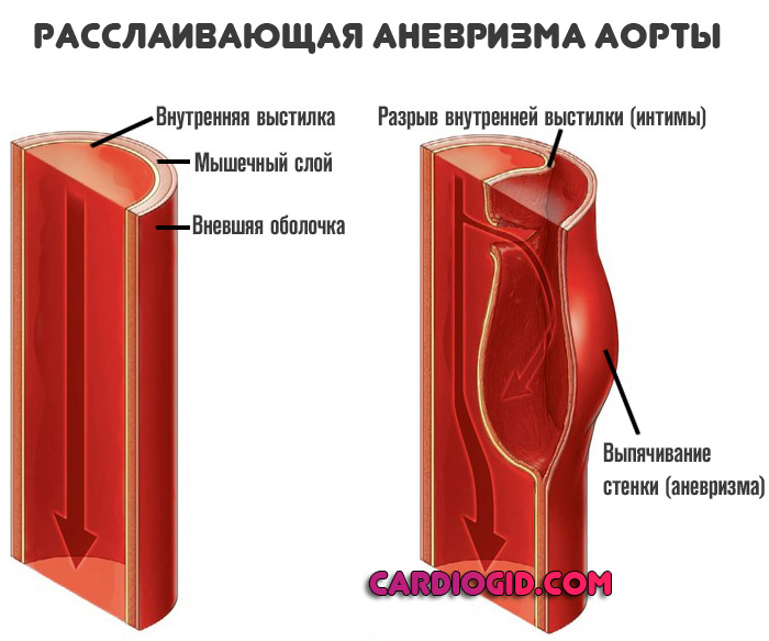 расслаивающая-аневризма-аорты-1