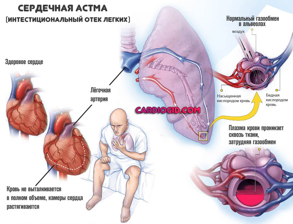 сердечная-астма