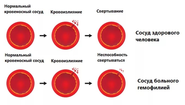 Свертывание крови: норма времени коагуляции в анализе и фазы процесса, причины отклонений и дополнительные обследования