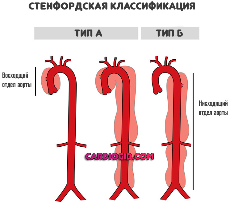 стенфордская-классификация-расслаивающей-аневризмы-аорты