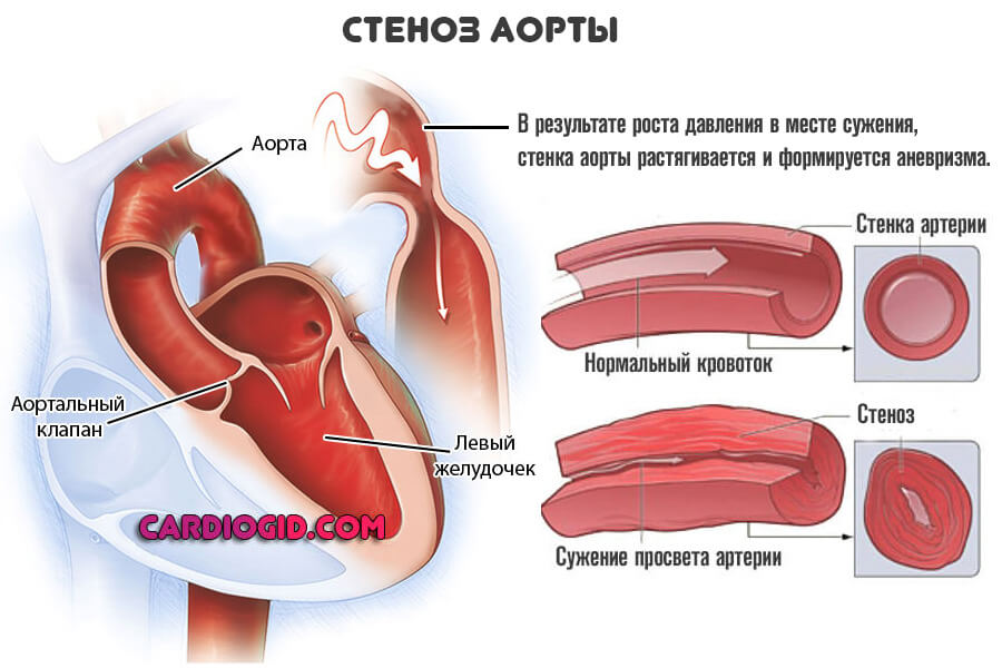 стеноз-аорты