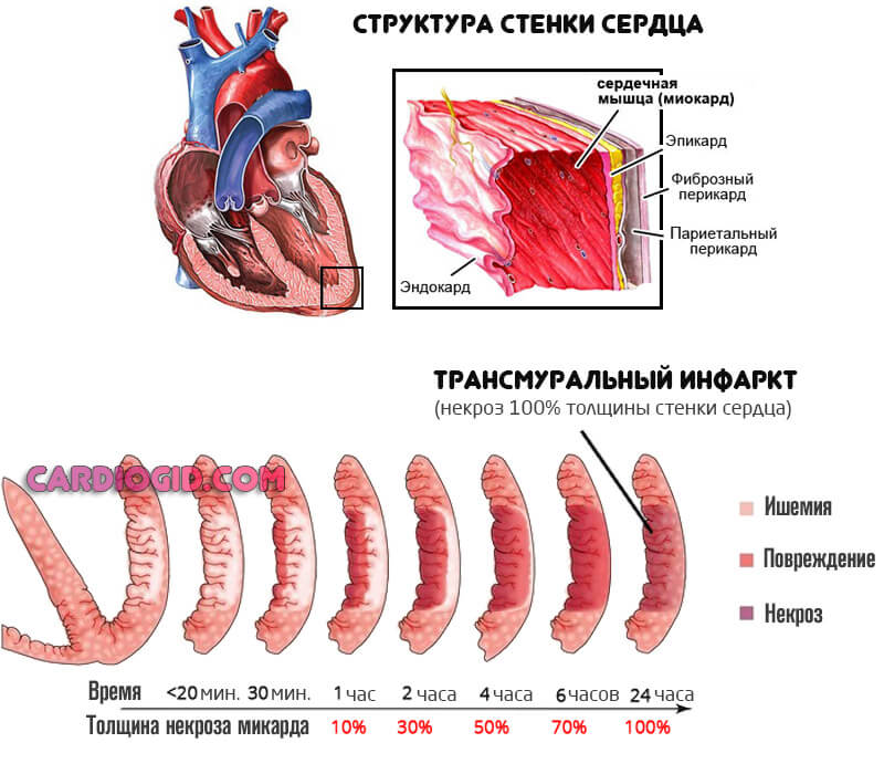 трансмуральный-инфаркт