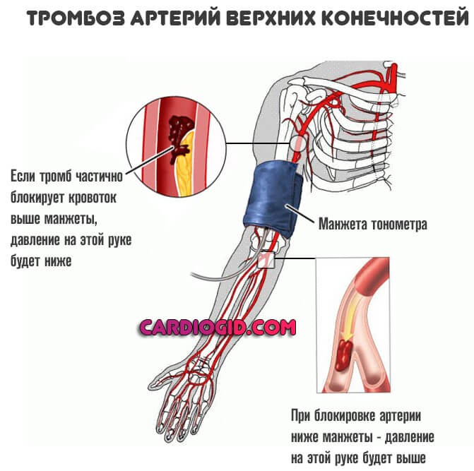 тромбоз артерий верхних конечностей