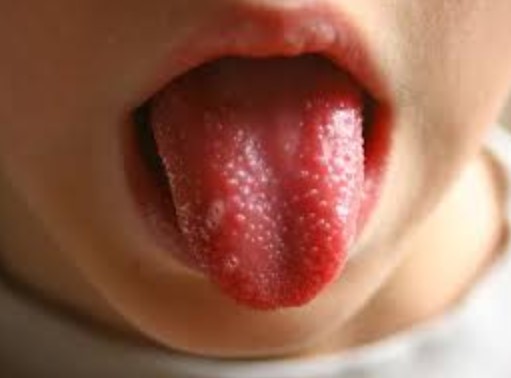 воспаление языка